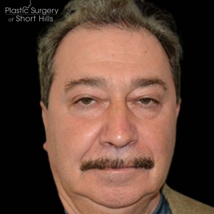 Blepharoplasty Before & After Patient #16219