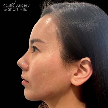 Rhinoplasty Before & After Patient #16228