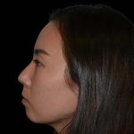 Rhinoplasty Before & After Patient #16228