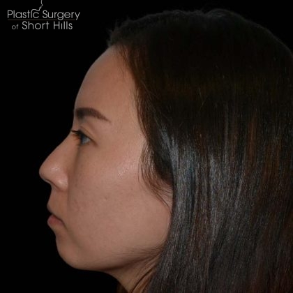 Rhinoplasty Before & After Patient #16228