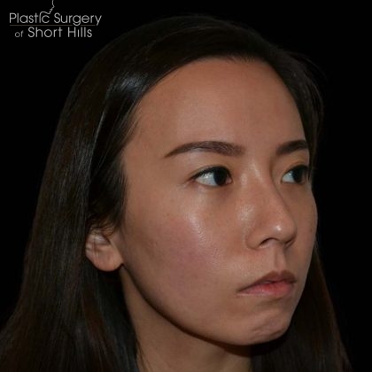 Rhinoplasty Before & After Patient #16228