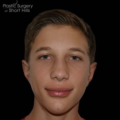Otoplasty Before & After Patient #16251