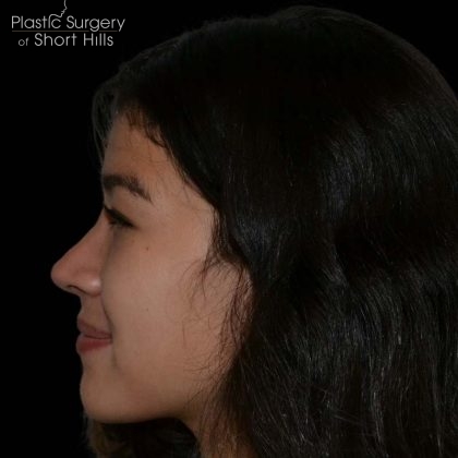 Revision Rhinoplasty Before & After Patient #16253