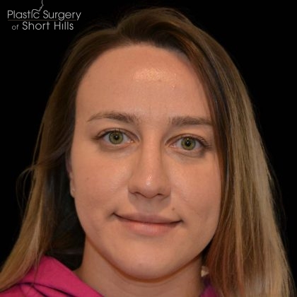 Rhinoplasty Before & After Patient #16175