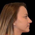 Rhinoplasty Before & After Patient #16175