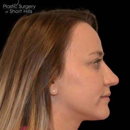 Rhinoplasty Before & After Patient #16175