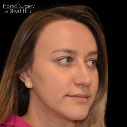 Rhinoplasty Before & After Patient #16175