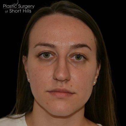 Rhinoplasty Before & After Patient #16175