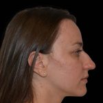 Rhinoplasty Before & After Patient #16175