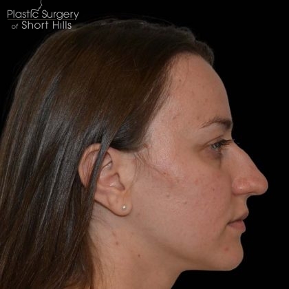 Rhinoplasty Before & After Patient #16175