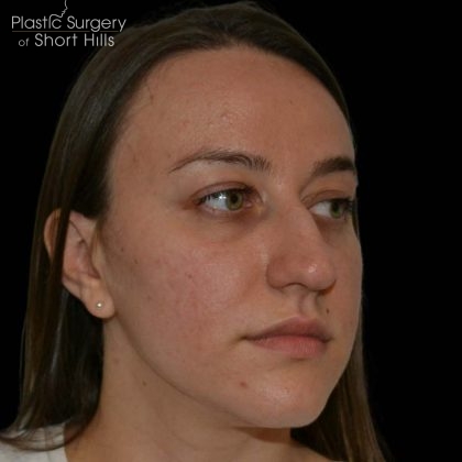 Rhinoplasty Before & After Patient #16175
