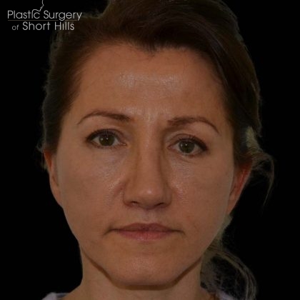 Rhinoplasty Before & After Patient #16174