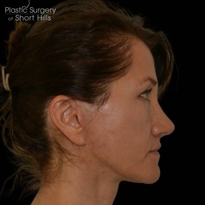 Rhinoplasty Before & After Patient #16174