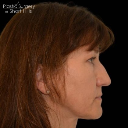 Rhinoplasty Before & After Patient #16174