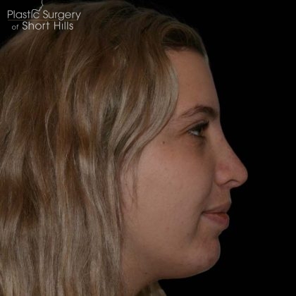 Rhinoplasty Before & After Patient #16180