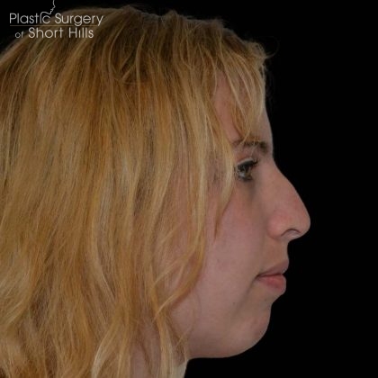 Rhinoplasty Before & After Patient #16180