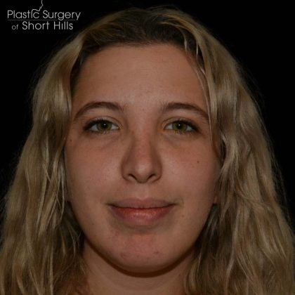 Rhinoplasty Before & After Patient #16180