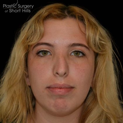 Rhinoplasty Before & After Patient #16180