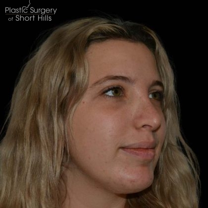 Rhinoplasty Before & After Patient #16180