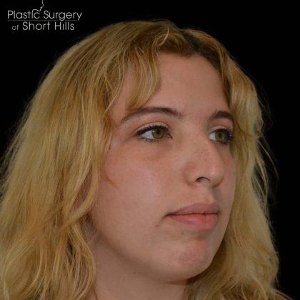 Rhinoplasty Before & After Patient #16180