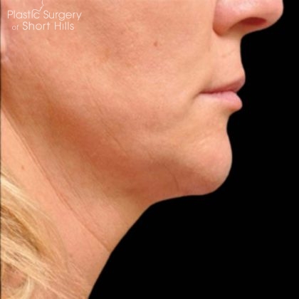 Ultherapy Before & After Patient #16255