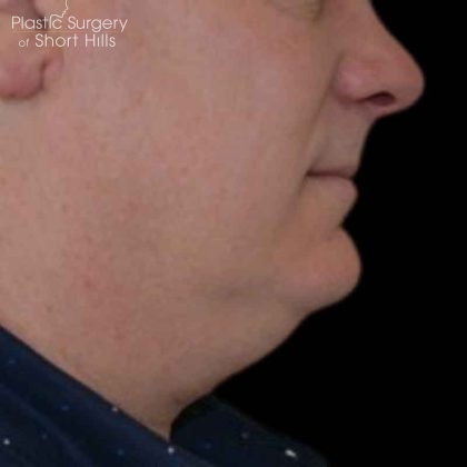 Liposuction-Face Before & After Patient #16417