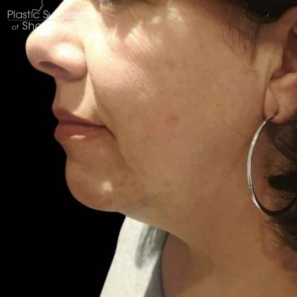RF Microneedling Before & After Patient #16372