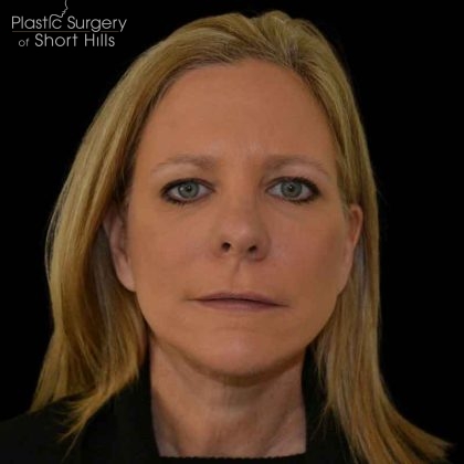 Facelift Before & After Patient #16364
