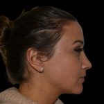 Rhinoplasty Before & After Patient #16563