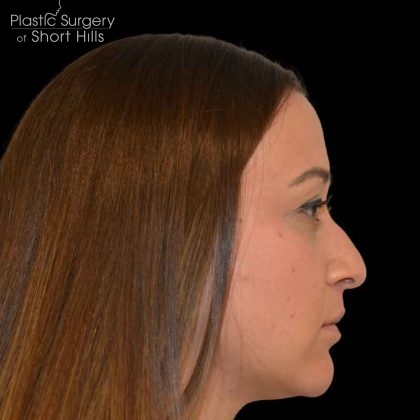 Rhinoplasty Before & After Patient #16563