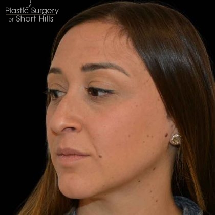 Rhinoplasty Before & After Patient #16563