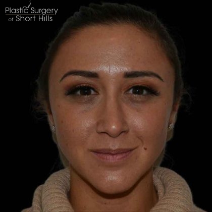 Rhinoplasty Before & After Patient #16563