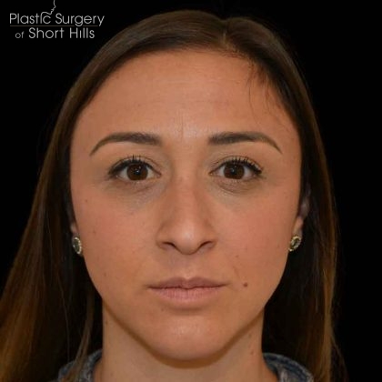 Rhinoplasty Before & After Patient #16563