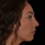 Rhinoplasty Before & After Patient #16485