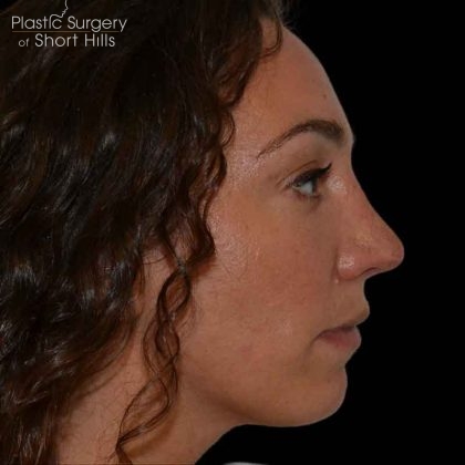 Rhinoplasty Before & After Patient #16485