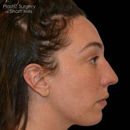 Rhinoplasty Before & After Patient #16485