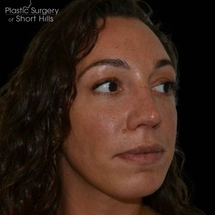 Rhinoplasty Before & After Patient #16485