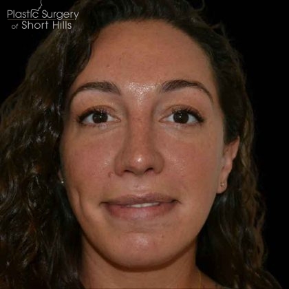 Rhinoplasty Before & After Patient #16485