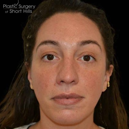 Rhinoplasty Before & After Patient #16485