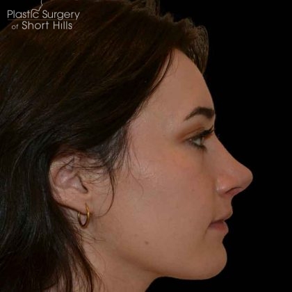 Rhinoplasty Before & After Patient #16486