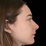 Rhinoplasty Before & After Patient #16486