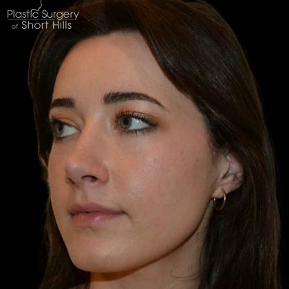 Rhinoplasty Before & After Patient #16486