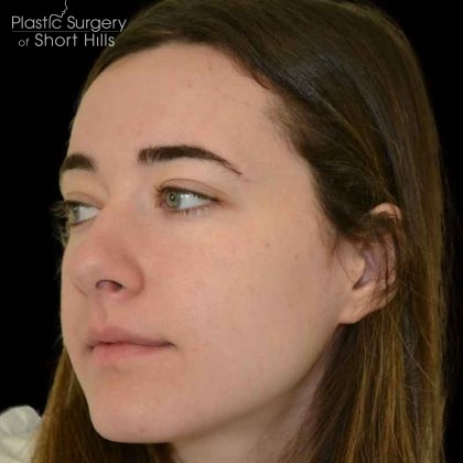 Rhinoplasty Before & After Patient #16486