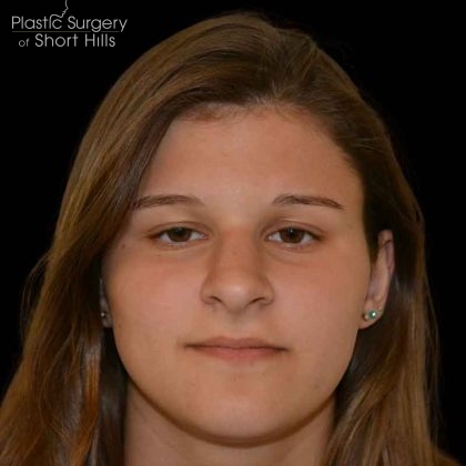 Rhinoplasty Before & After Patient #16487