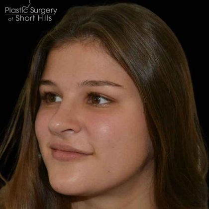 Rhinoplasty Before & After Patient #16487