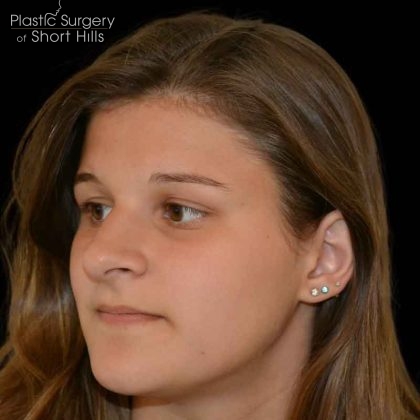 Rhinoplasty Before & After Patient #16487