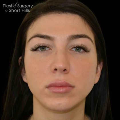 Rhinoplasty Before & After Patient #16488