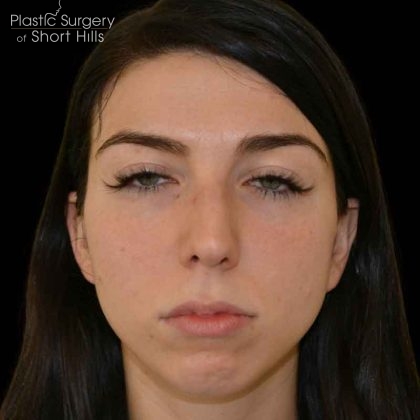 Rhinoplasty Before & After Patient #16488