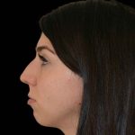 Rhinoplasty Before & After Patient #16488