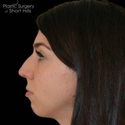 Rhinoplasty Before & After Patient #16488